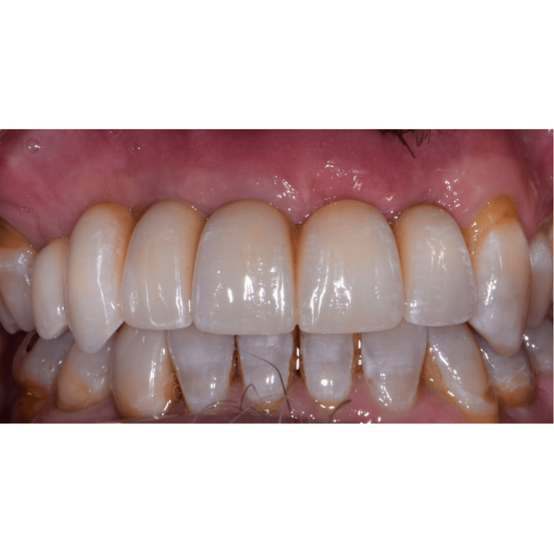 After image
